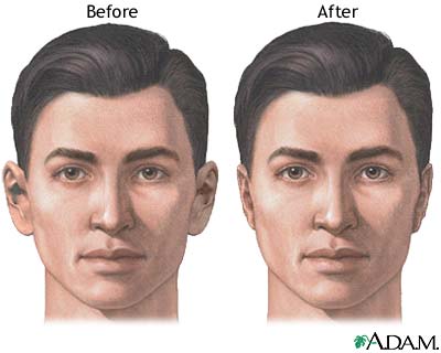 ear surgery before and after