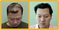 hair transplant men picutre