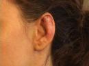 ear surgery videos