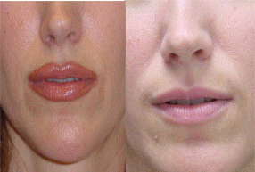 Lips Surgery before and after