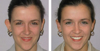 ear surgery before and after